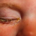 Conjuntivitis bacteriana - Infección de los ojos Venezuela