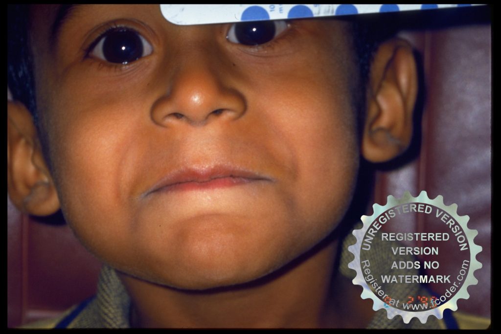 Megalocornea - Glaucoma infantil (congénito) - Dr. Alvaro Sanabria - Oftalmología pediátrica - Venezuela
