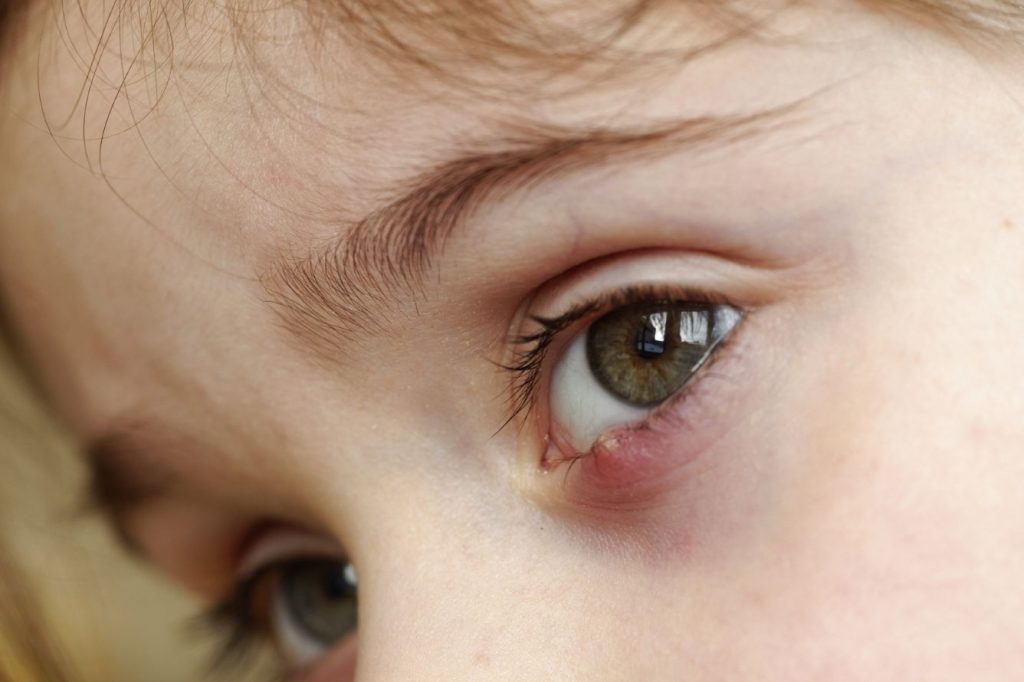 Orzuelos y Chalazión - Enfermedades comunes de los ojos - Oftalmología