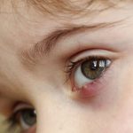 Orzuelos y Chalazión - Enfermedades comunes de los ojos - Oftalmología