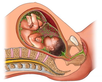 Conjuntivitis Neonatal - Infección a través del parto por vía vaginal - Oftalmología pediátrica - Dr. Alvaro Sanabria