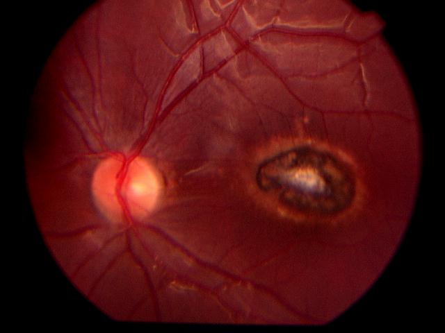 Foto 4 - Toxoplasmosis Ocular - Enfermedades infeccionas de la retina - Oftalmología pediátrica - Dr. Alvaro Sanabria