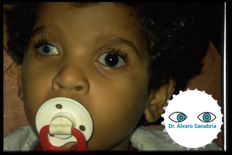 Foto 2 - Esclerocórnea - Caso especial de oftalmología pediátria - Dr. Alvaro Sanabria