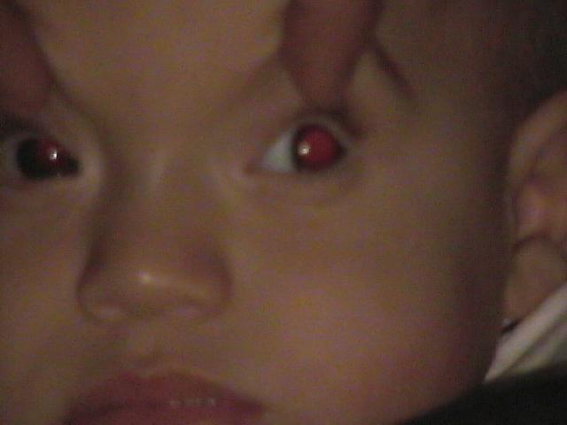 Presencia del reflejo rojo en pupilas - Oftalmología pediátrica - Dr. Alvaro Sanabria