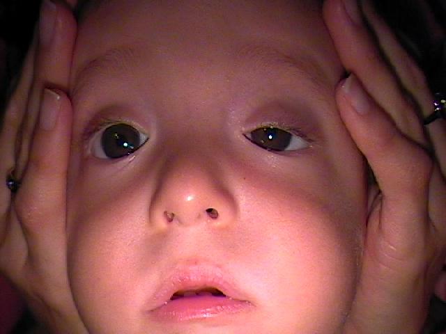 Ptosis palpebral en niños - Párpados caídos - Oftalmología pediátrica - Dr. Alvaro Sanabria