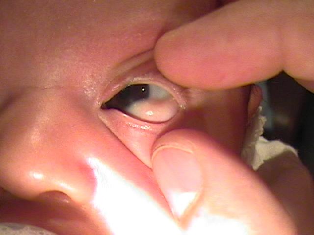 Foto 5 - Dermoide Epibulbar - Casos especiales de oftalmología pediátrica - Dr. Alvaro Sanabria