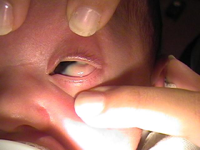 Foto 2 - Dermoide Epibulbar - Casos especiales de oftalmología pediátrica - Dr. Alvaro Sanabria