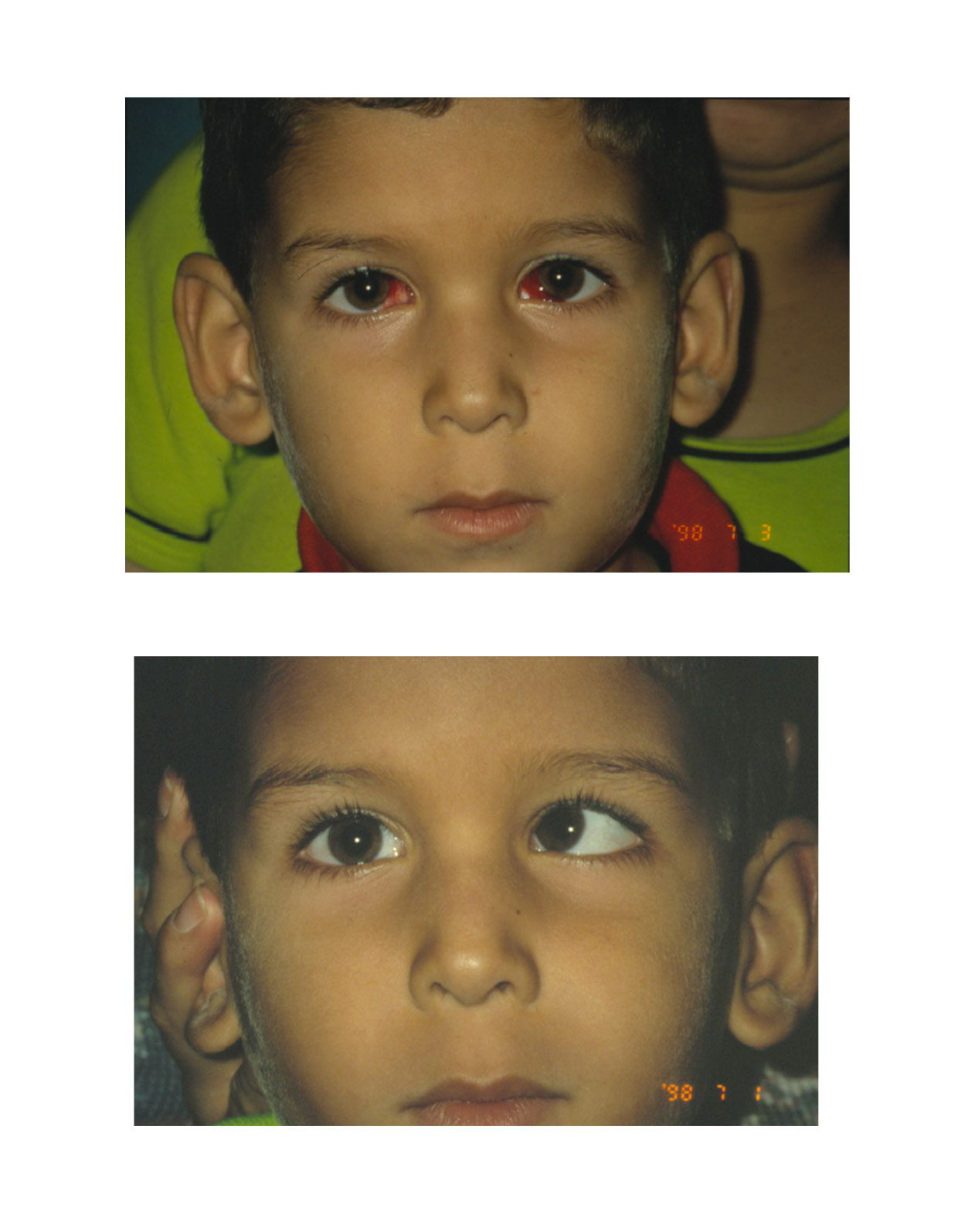 Niño con Estrabismo - Imágenes de antes y después del tratamiento - Oftalmología pediátrica - Dr. Alvaro Sanabria