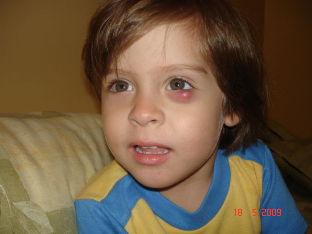 Niño con orzuelo - Inflamación - Oftalmología pediátrica - Dr. Alvaro Sanabria