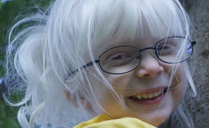 Albinismo ocular - Oftalmología pediátrica - Niños albinos oculocutáneo