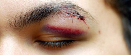Accidentes oculares - Oftalmología en Caracas, Margarita y Venezuela