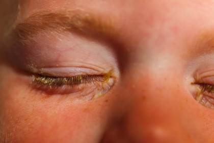 Conjuntivitis bacteriana - Infección de los ojos Venezuela