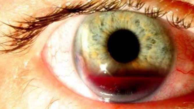 Hifemia ocular - Oftalmología en Venezuela - Dr. Alvaro E. Sanabria Villarruel