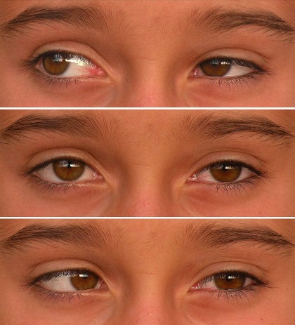 Motilidad ocular - Examen del niño preverbal